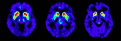 Fdopa Positive Scan (Fdopa Positive Scans)